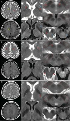 Different Perivascular Space Burdens in Idiopathic Rapid Eye Movement Sleep Behavior Disorder and Parkinson’s Disease